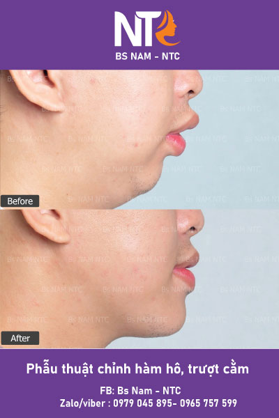 Chỉnh Hàm Hô Cằm Lẹm