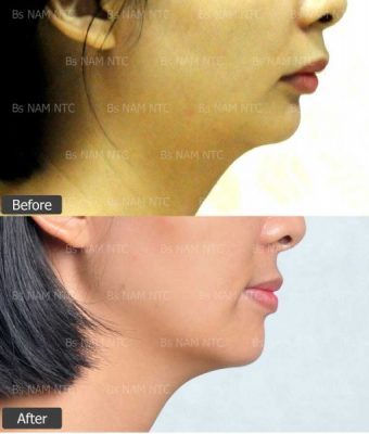 Chỉnh Hàm Hô Cằm Lẹm
